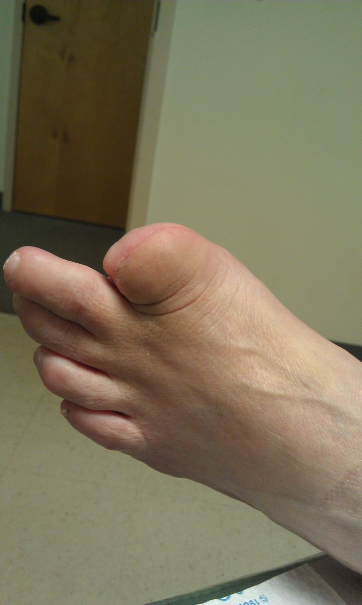 first toe amputation.jpg