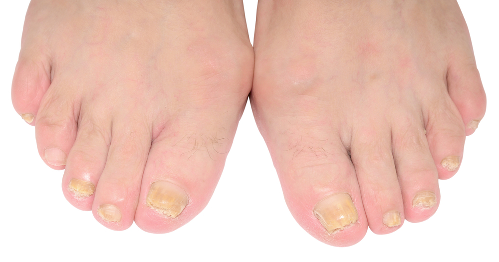 Laser fungal toenails — LIGHTHOUSE FOOT & ANKLE CENTER