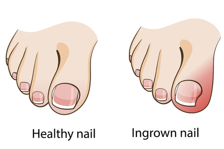 Take Care of an Ingrown Toenail Before It Gets Worse — LIGHTHOUSE FOOT &  ANKLE CENTER