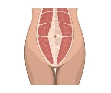 diastasis-recti-example.jpg