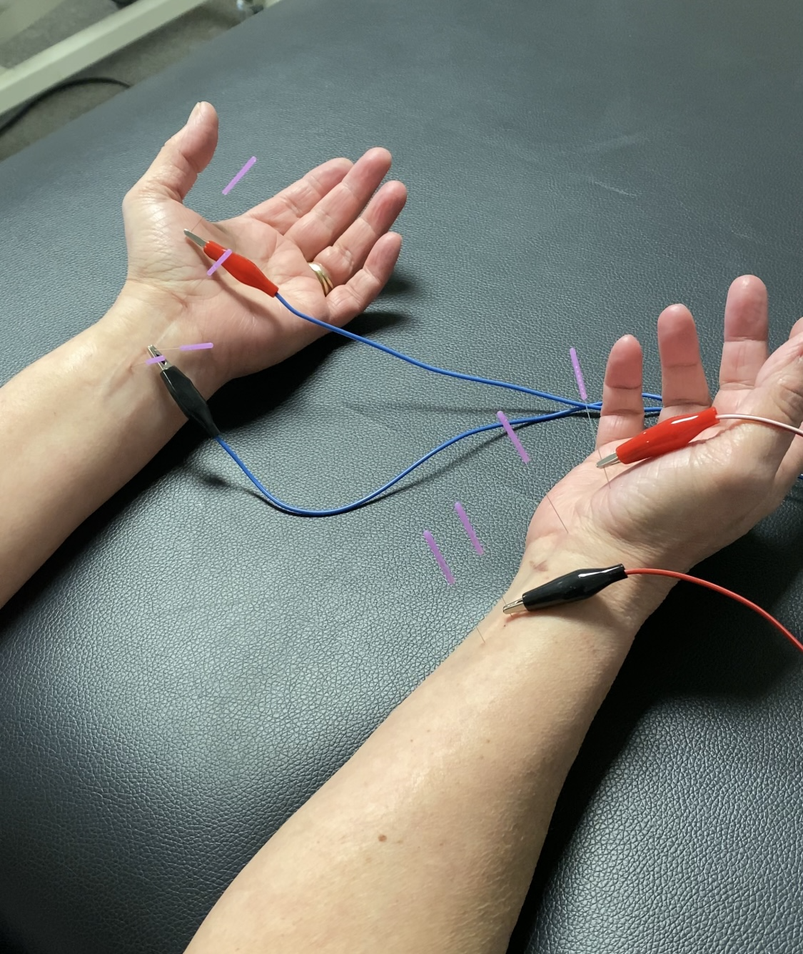 Trigger Points and Carpal Tunnel Syndrome — Lanier Therapy in Motion