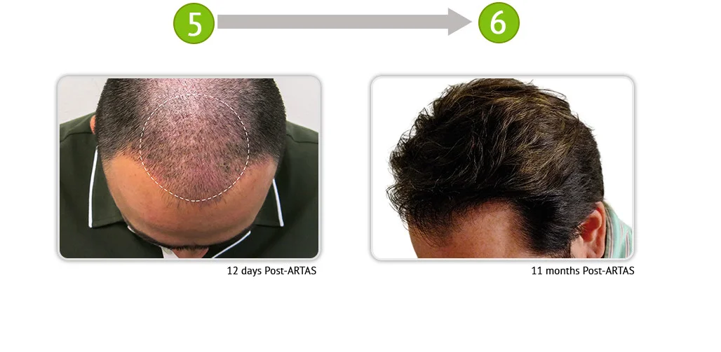 Photos courtesy of Dr. Yates Hair Sciences, William D. Yates, MD