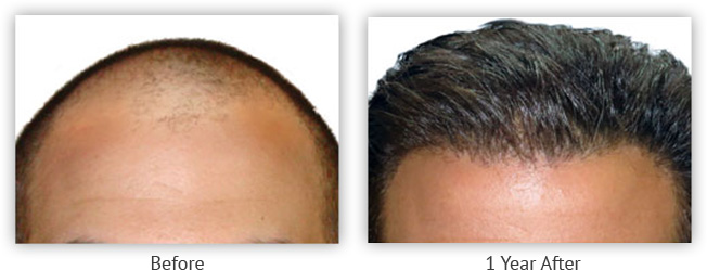 Photos courtesy of the New Horizons Center for Cosmetic Surgery, Gregory A. Turowski, MD *Date on file