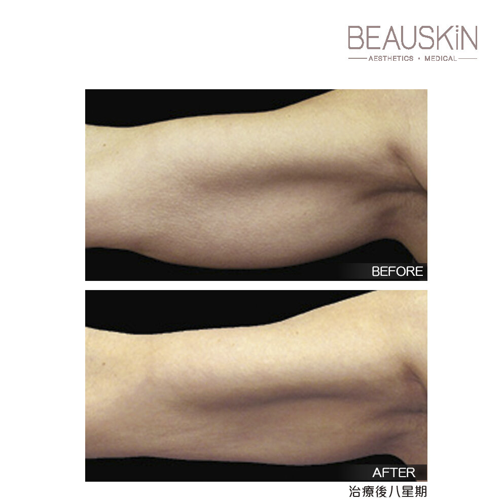 Coolsculpting - BEAUSKIN Medical