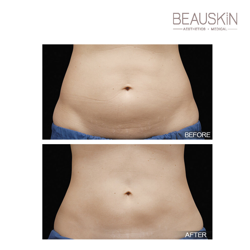 Coolsculpting - BEAUSKIN Medical