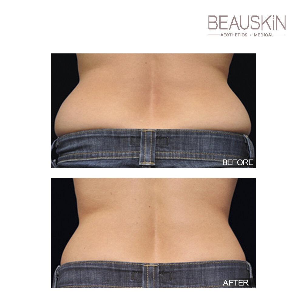 Coolsculpting - BEAUSKIN Medical