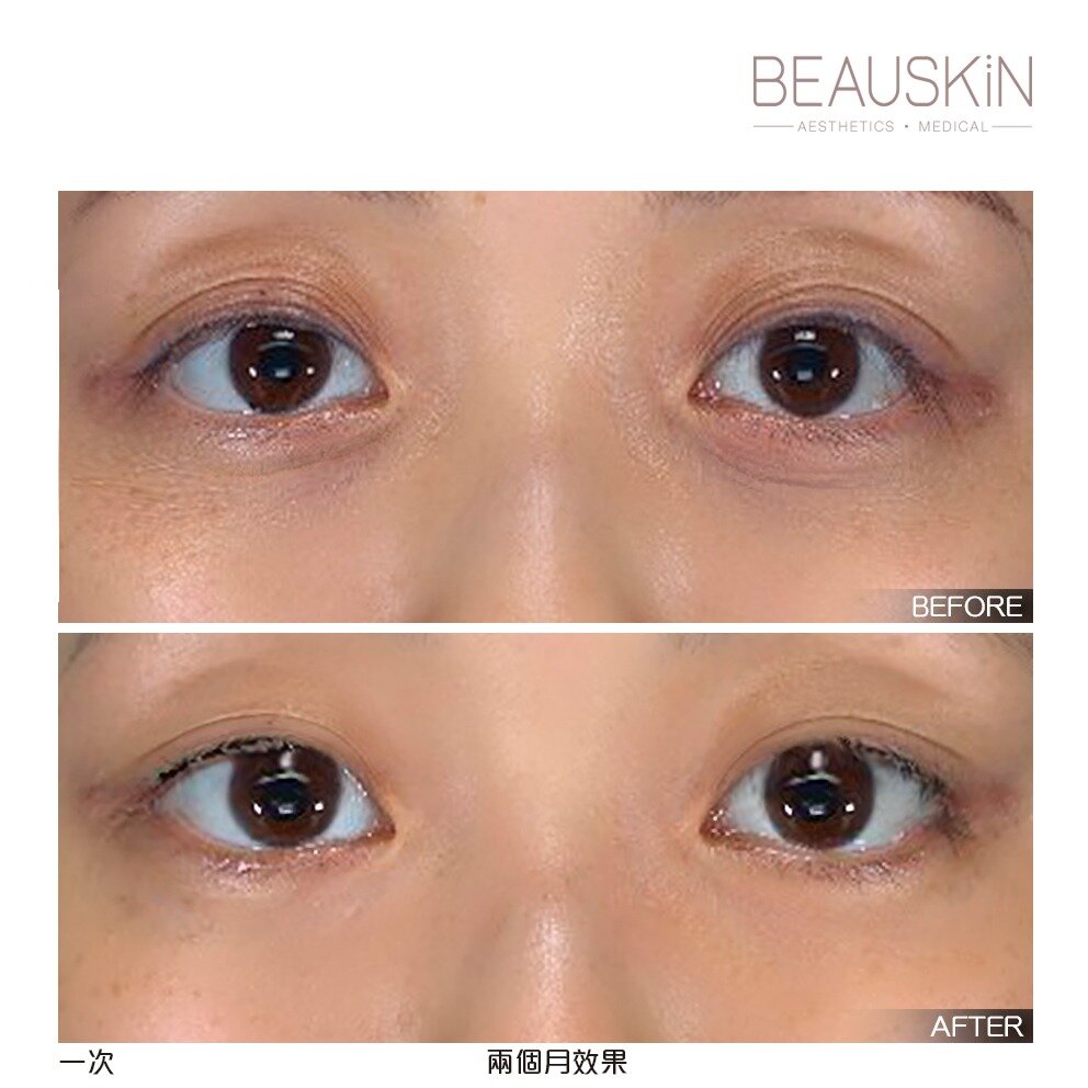 Thermage Eye - BEAUSKIN Medical