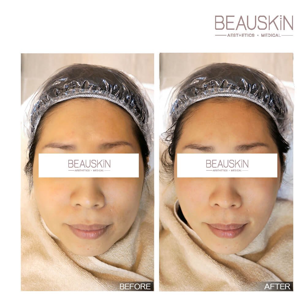 Thermage Eye - BEAUSKIN Medical