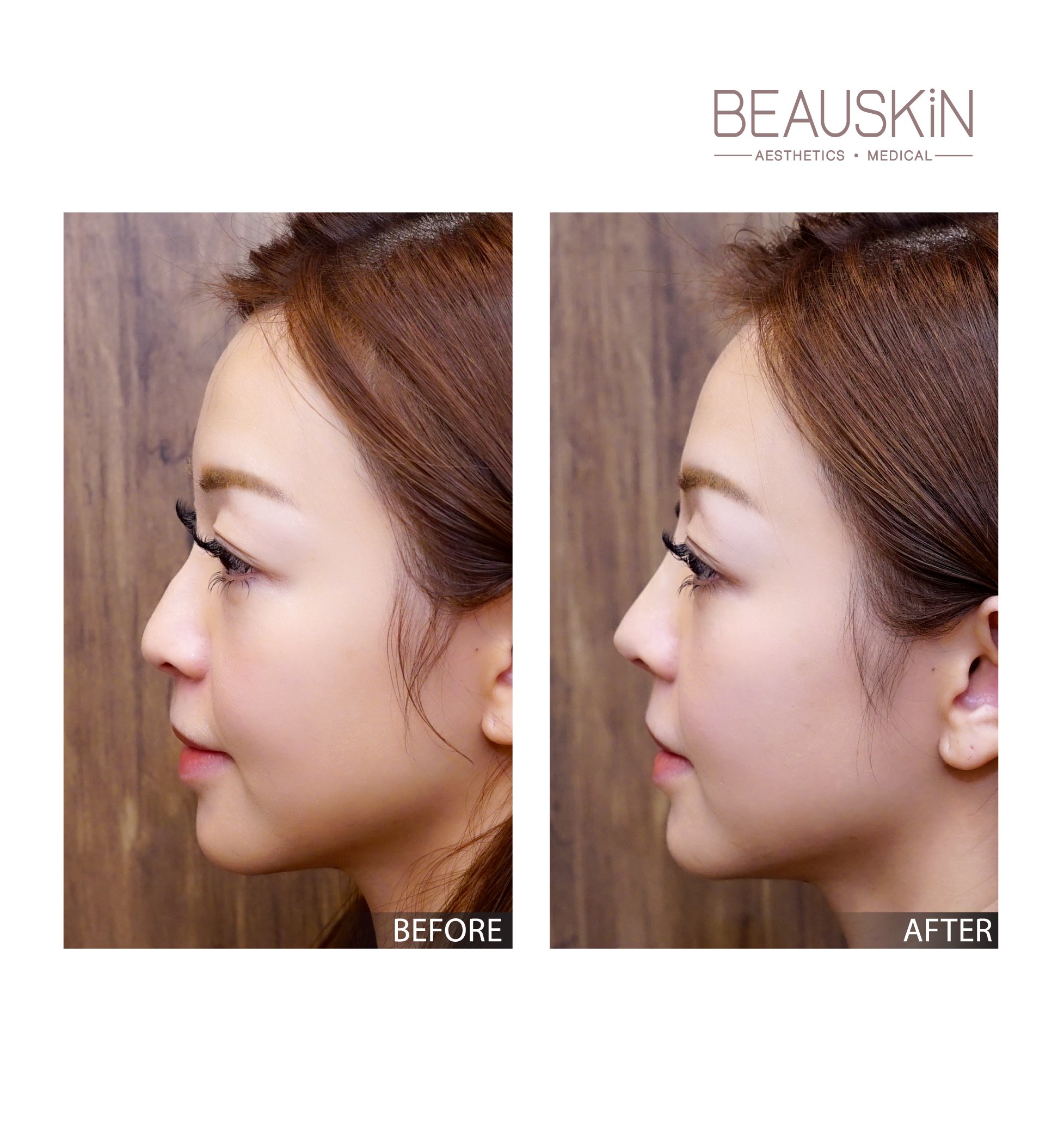 隱形支架塑鼻 - BEAUSKIN Medical