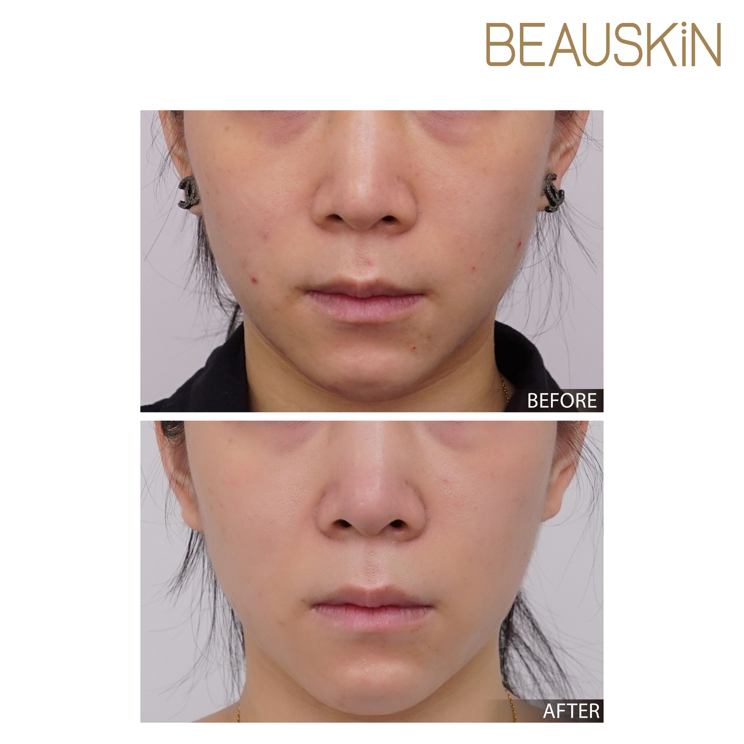 Nordlys MIRROR 鏡光肌 - BEAUSKIN Medical (Copy)