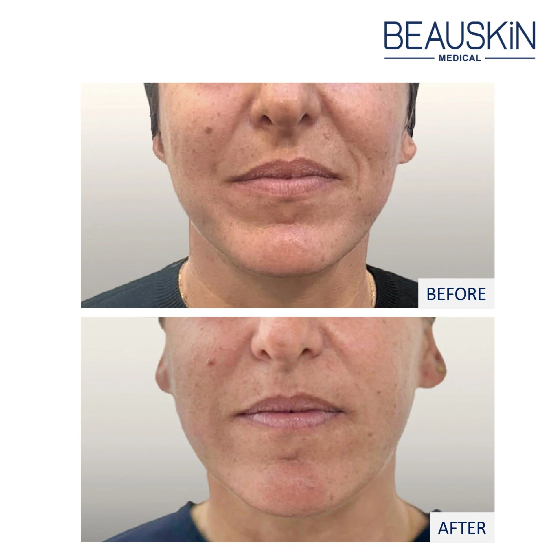 JULÄINE 緻麗顏 膠原活性再生 — BEAUSKIN MEDICAL