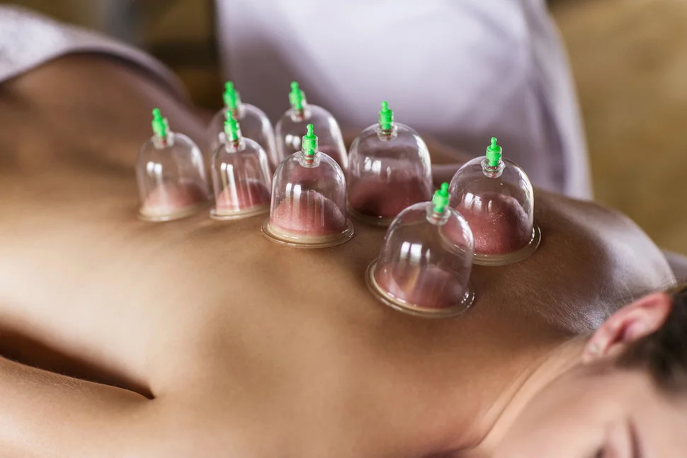 Can Cupping Promote Healing and Pain Relief?