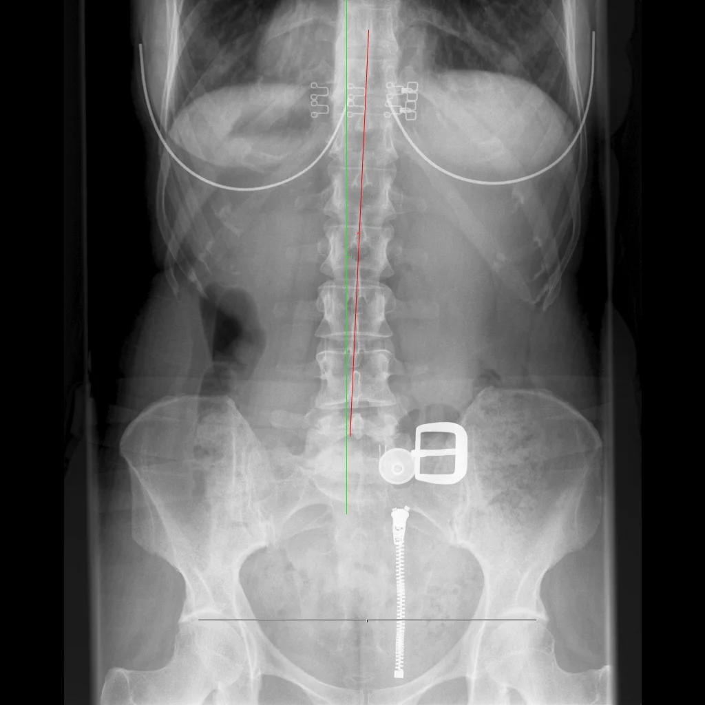 Spine-Lumbar Spine AP-28_10_2015-16_28_07-495.JPEG