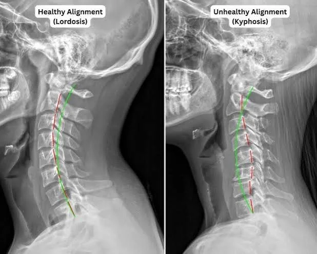 Resolving "Tech Neck" and Desk-Related Pain