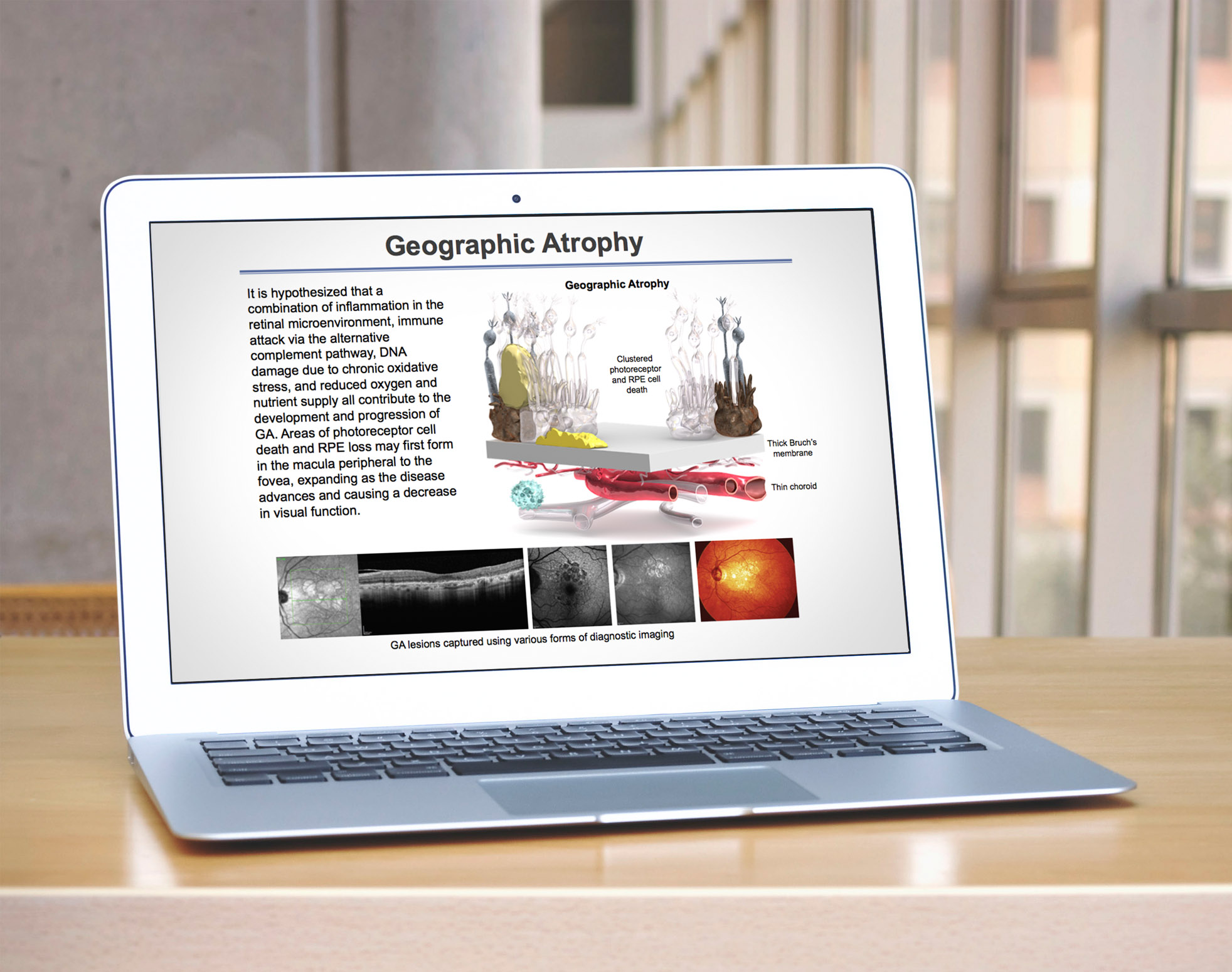 Geographic Atrophy Presentation.jpg