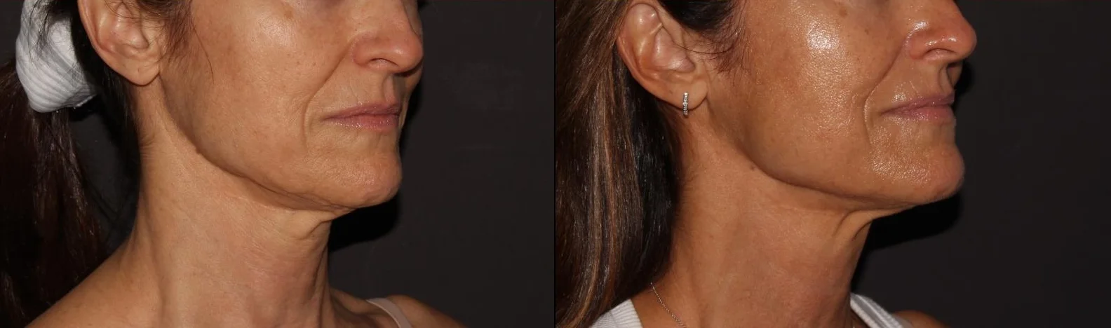 This patient had an Ultherapy treatment of her lower face and upper neck to lift and tighten the skin. The after photo was taken 9 months later.