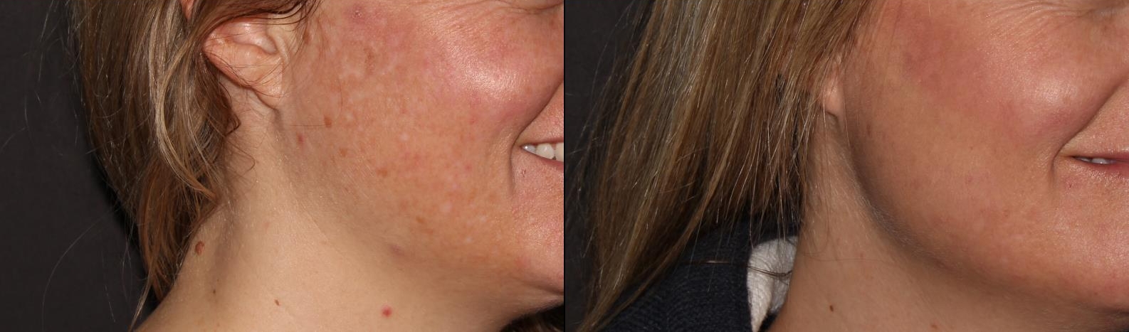 IPL treatment for color correction. Photos taken 2 weeks apart.
