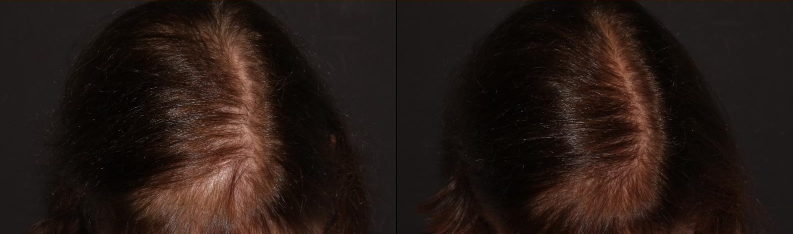 These photos were taken 4 months apart following a series of 3 PRP for hair restoration.