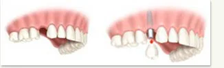 single_tooth_embed2.jpg