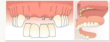 multi_tooth_embed2.jpg