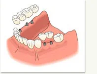 multi_tooth_embed3.jpg