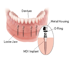 implant-supported-denture.gif
