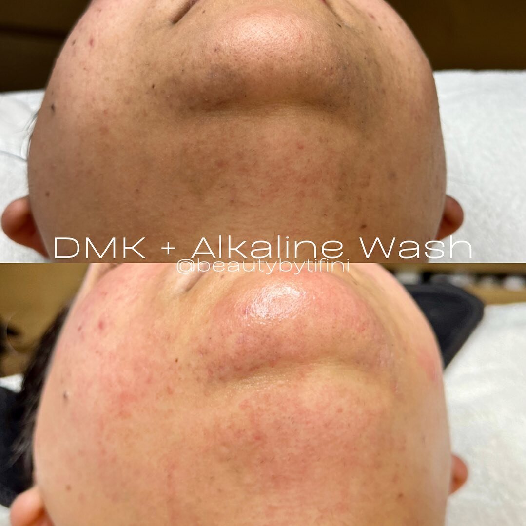 ALKALINE WASH is a painless, unique, and professional treatment that can lighten hyperpigmentation and remove unwanted facial hair like this you see above on her chin!😱

This is a very specific type of exfoliation that requires a little prep work to
