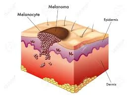 New genetic variant found to influence melanoma risk