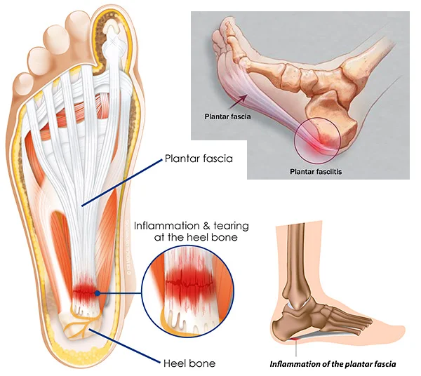plantar-fasciitis-01.jpg