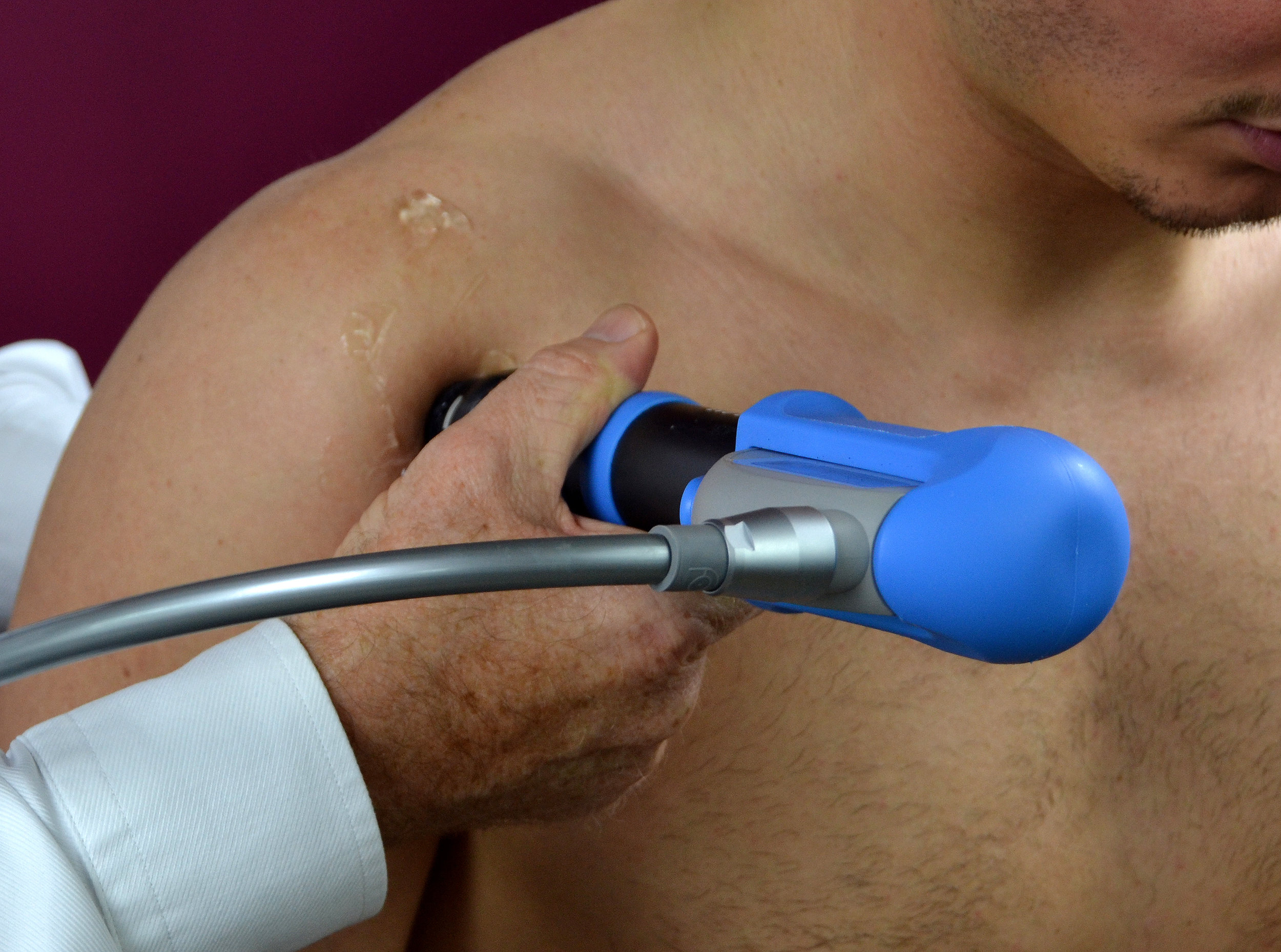 Shoulder Pain — Shockwave Therapy