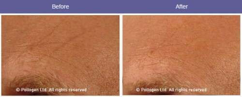 Facial dermal volumizing using microneedling head with RF after 3 treatments.