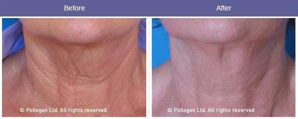 Neck skin tightening after 6 treatments. Courtesy of Dr. DvoraAncona.