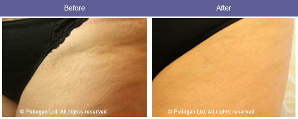 Stretch mark reduction.