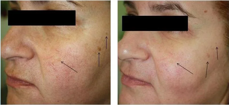 After a series of NeoBright treatments. Courtesy of Pollogen . 