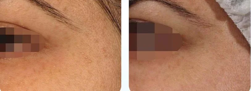 After 5 NeoBright weekly treatments. Courtesy of Pollogen . 