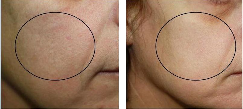After a series of NeoRevive treatments. Courtesy of Pollogen. 