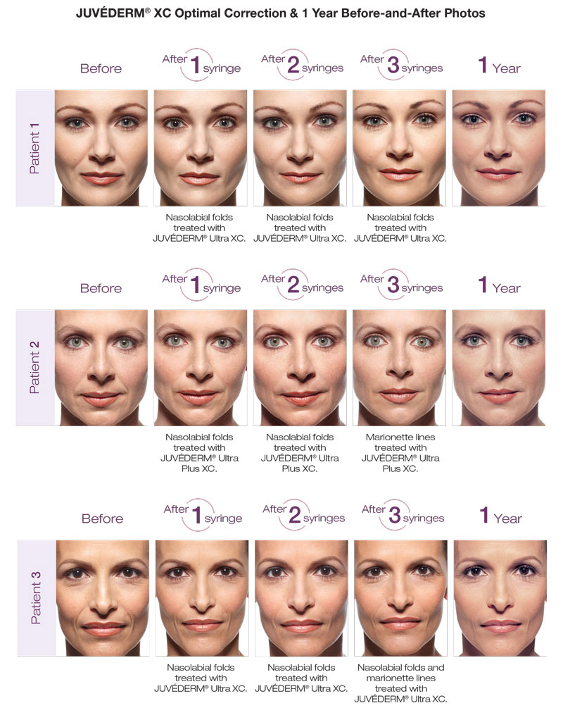 Dermal fillers for nasolabial folds (the lines that run from the nose to the corners of the mouth) and marionette lines (the parentheses around the corners of the mouth).