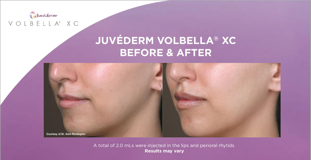 Lip injection using Juvederm Volbella XC which is a more subtle product to add lip volume and soften the appearance of lip lines.