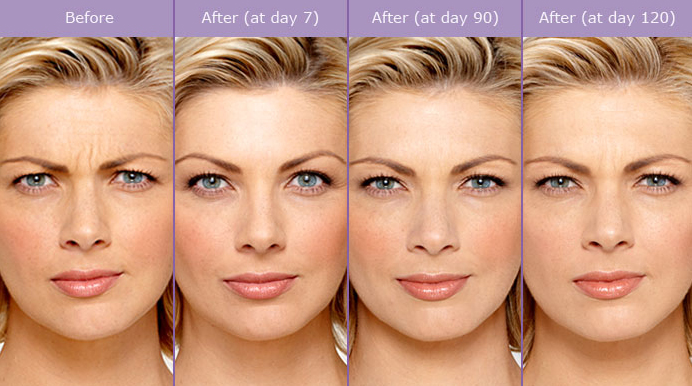 Botox for frown lines. Notice even after the Botox is gone, the frown lines are not as prominent as they were before the injection.