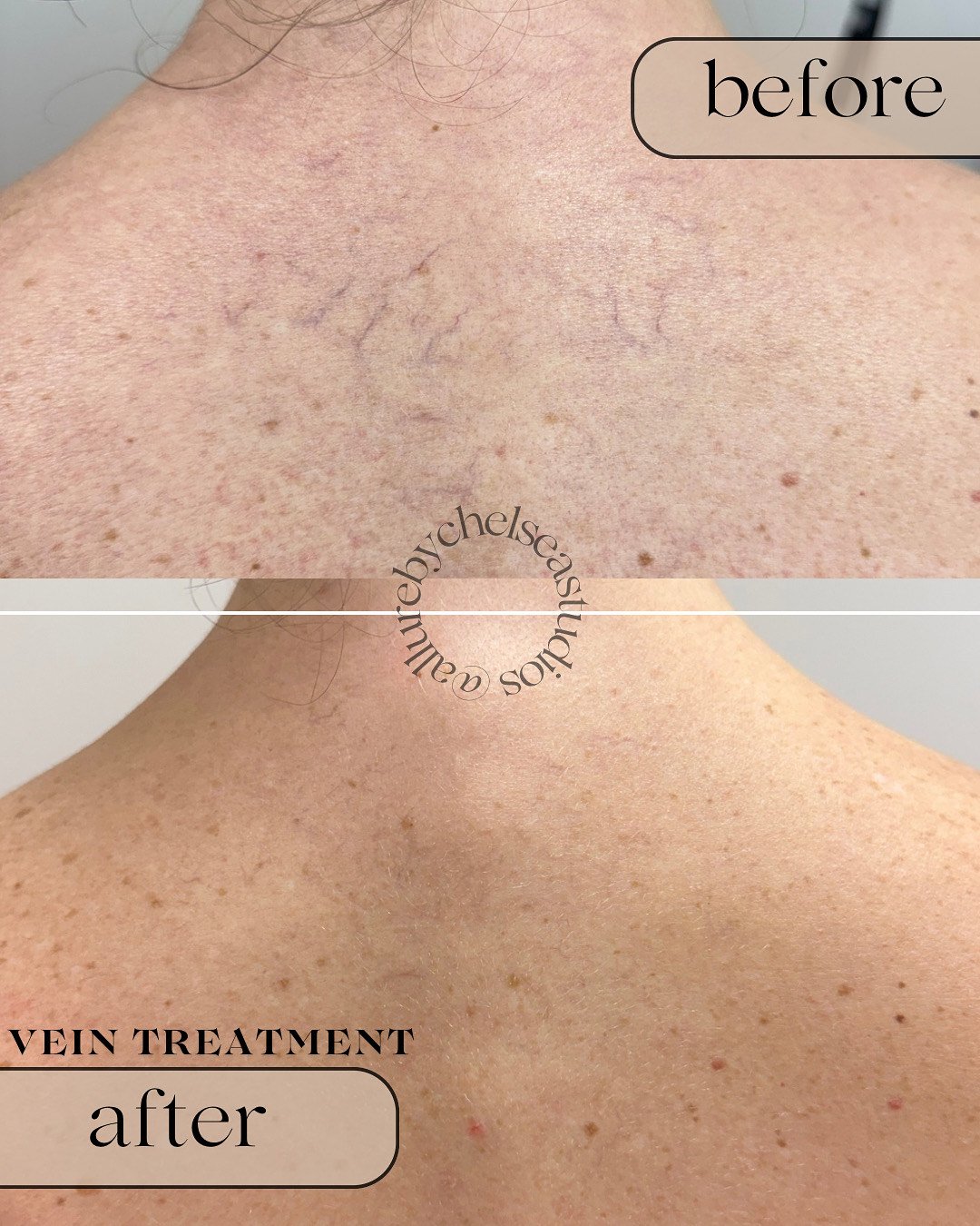 Before and after image of vein treatment (one session) using the clarity II laser device at allure by chelsea studios in st. albert alberta