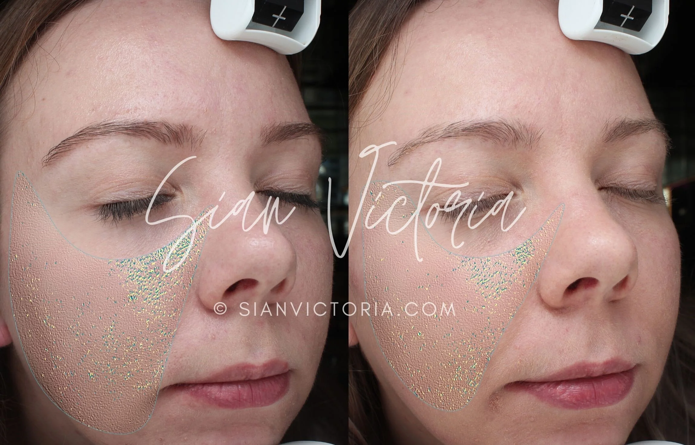 environ acne scars