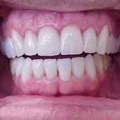 All ceramic crowns. This could be you!