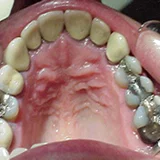Stained, failed caps and fillings.
