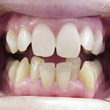 Micro-abrasion and whiting on upper teeth.