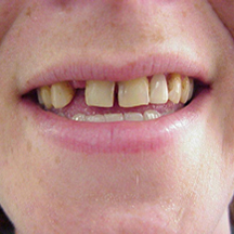 Missing teeth, failed caps and fillings.
