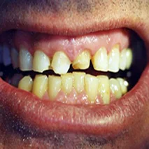 Gaps between lower teeth.