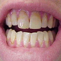 Misshapen, discolored front teeth.