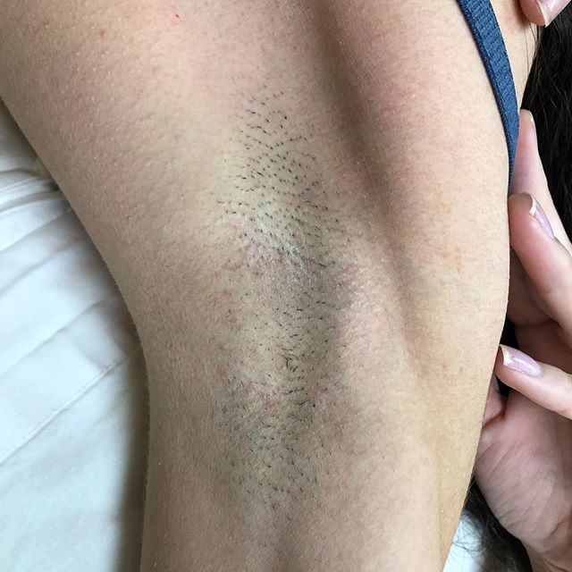 Before laser hair removal! Check out previous post to see the results of only one treatment !