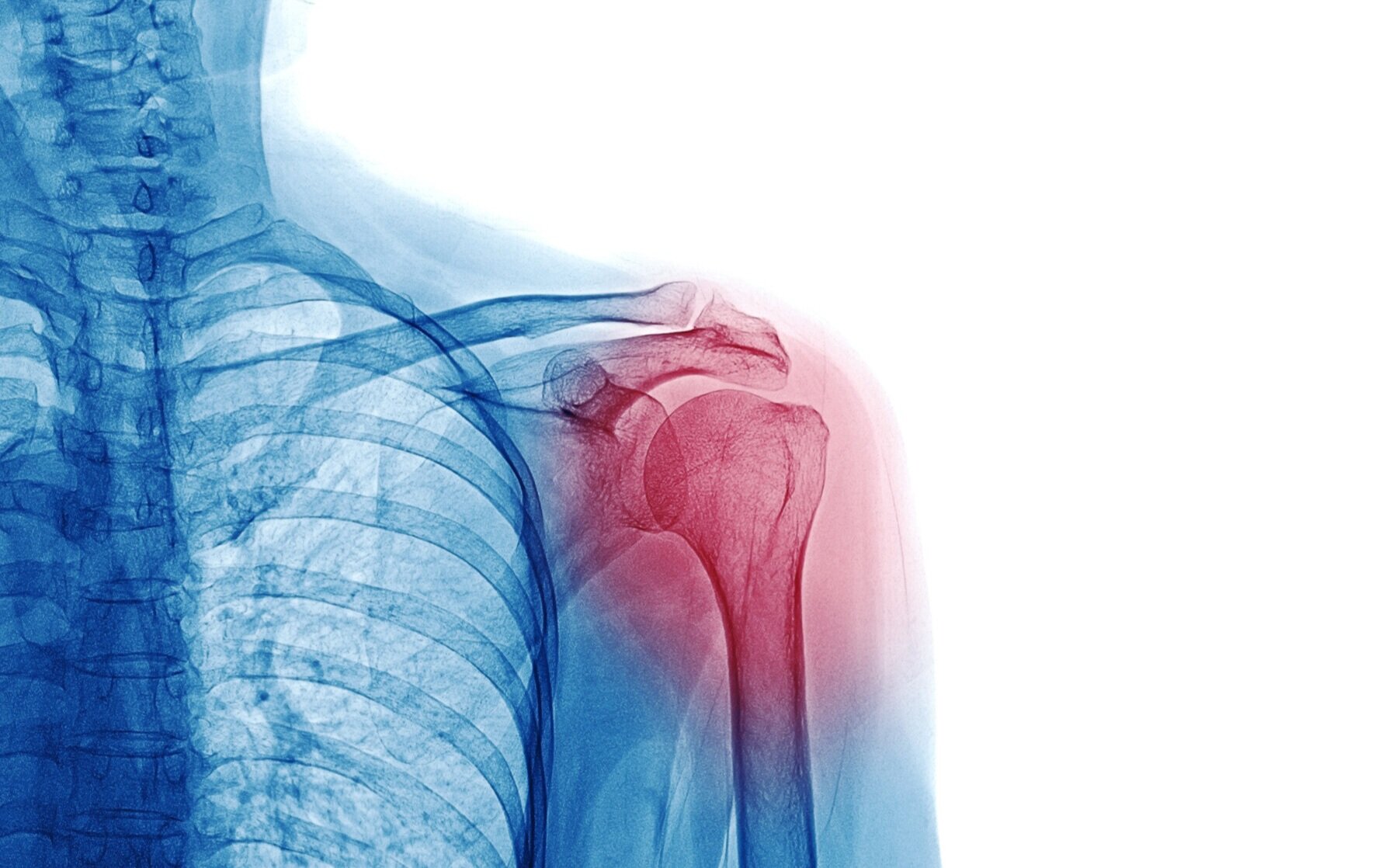 Shoulder injury related to vaccine Administration. Gunshot injury patterns.