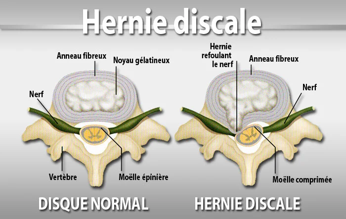 Fig 3 : hernie discale.